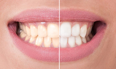 Teeth Whitening Burlington ON - Before and after Teeth whitening