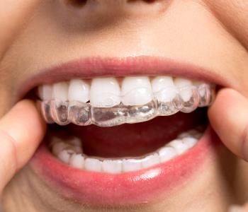 invisalign teeth braces from dentist in burlington