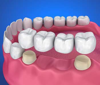 3D image of dental crown & bridge