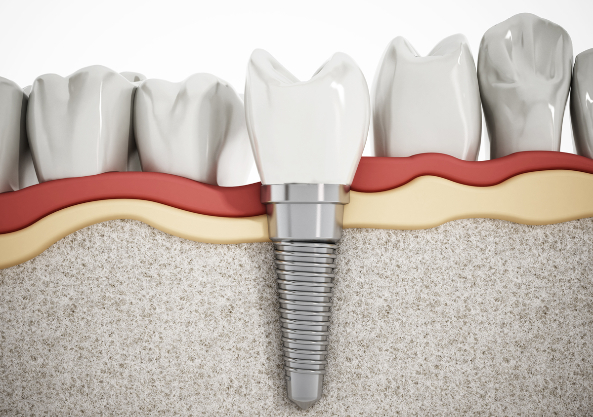 Learn About Dental Implant Systems in Burlington ON Area