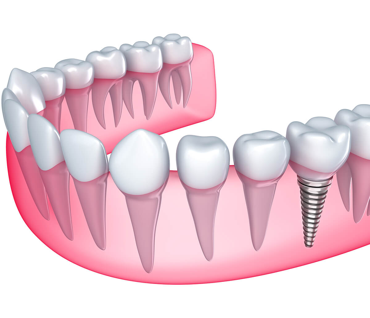 Dental Implant After Extraction in Burlington ON Area