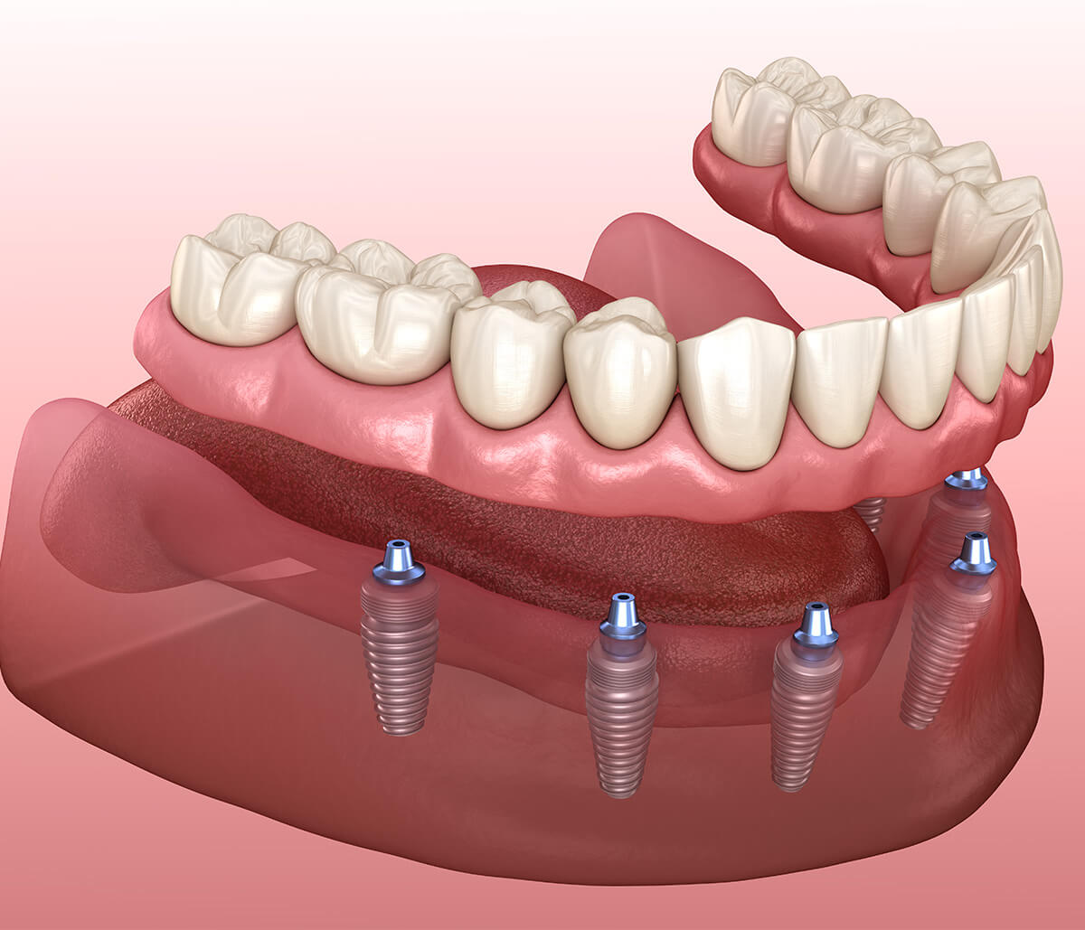 Benefits of All on 4 Dental Implants in Burlington ON Area