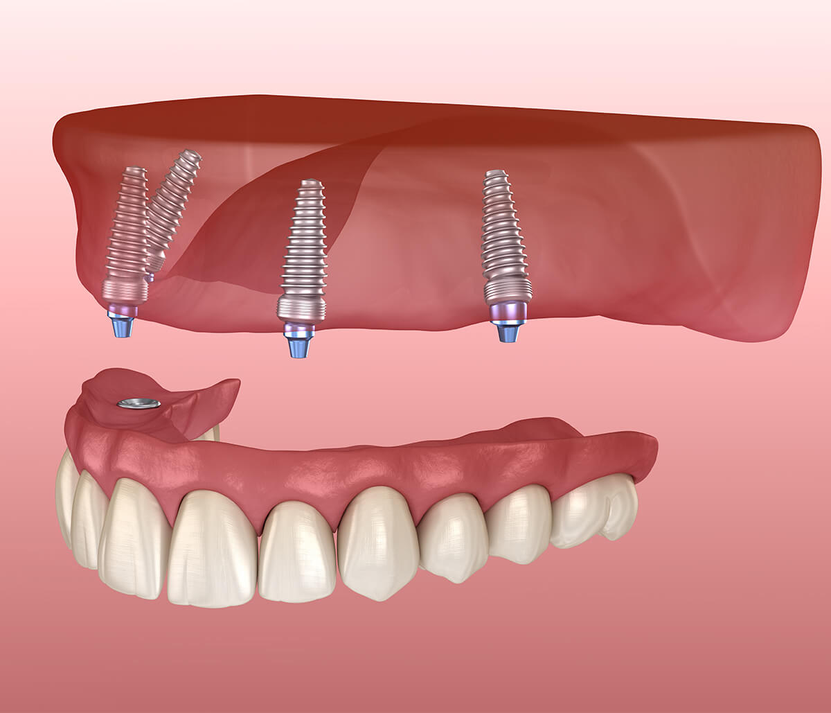 Affordable 4 Dental Implants Near Me Burlington ON Area