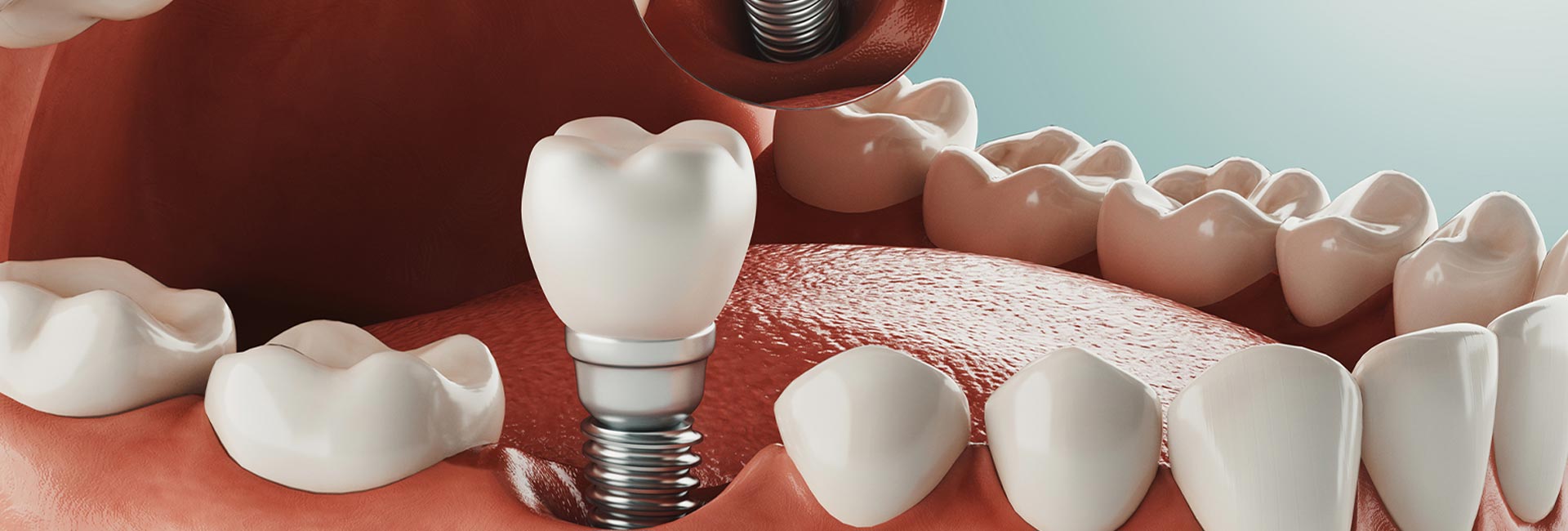 3D Illustration of dental implant